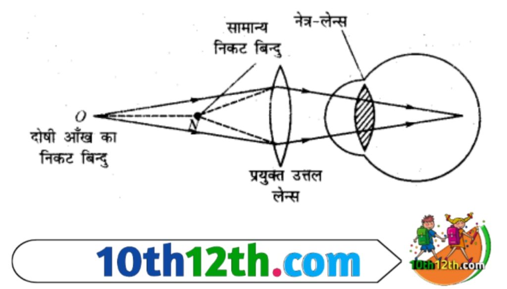 इस दोष से युक्त नेत्र द्वारा मनुष्य को दूर की वस्तुएं तो स्पष्ट दिखाई देती है परंतु समीप की वस्तुएं स्पष्ट नहीं दिखाई देती है अर्थात नेत्र का निकट बिंदु 25 सेंटीमीटर से अधिक दूर हो जाता है